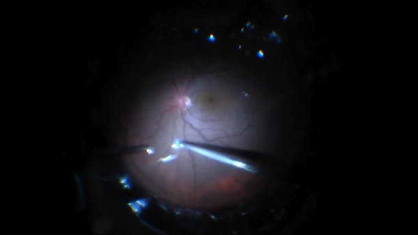 Complex Retinal Detachment thumbnail