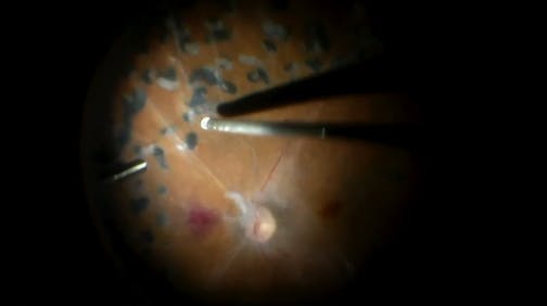 Vitreous Hemorrhage and Full-Thickness Macular Hole
