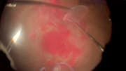 Diabetic Vitrectomy