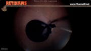 Retinal Graft