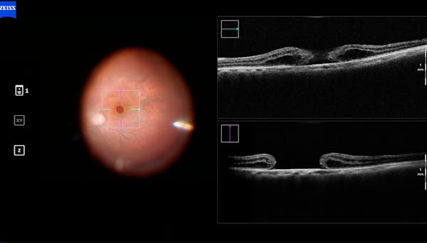 Large Macular Hole thumbnail