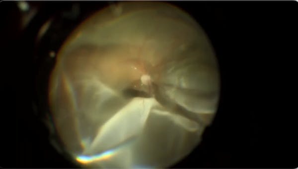 Subretinal Membrane thumbnail