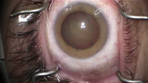 Post-Vitrectomy Acute Cataract