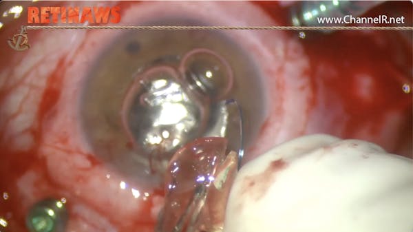 Subretinal Oil thumbnail