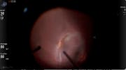 Traumatic Macular Tear