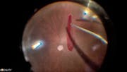 Retrobular Block