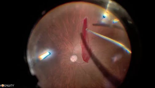 Retrobular Block