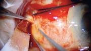 Suprachoroidal Hemorrhage