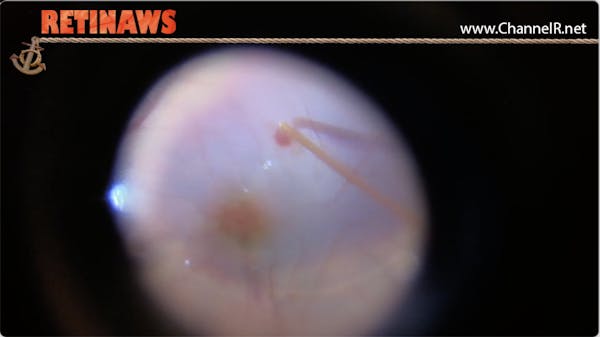 Subretinal TPA thumbnail