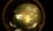 Endogenous Endophthalmitis