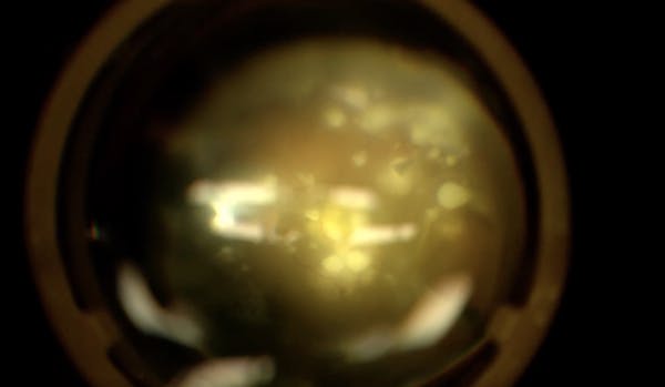 Endogenous Endophthalmitis thumbnail