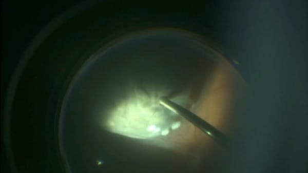 Endoresection thumbnail