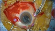 IOL Extraction