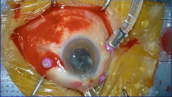 IOL Extraction thumbnail