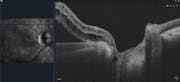 Optic Nerve Pit