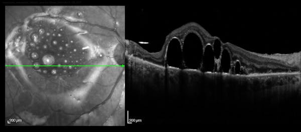 Submacular Perfluoron thumbnail