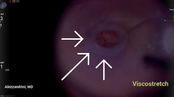 Viscostretch in Macular Hole Surgery thumbnail