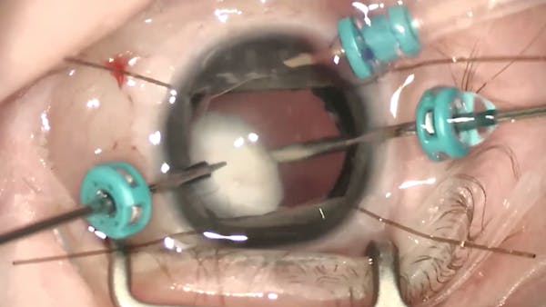 Severe Anterior Persistent Fetal Vasculature thumbnail