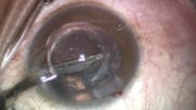 In Despair: A True Story about Life with Keratoconus