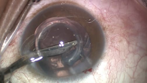 In Despair: A True Story about Life with Keratoconus