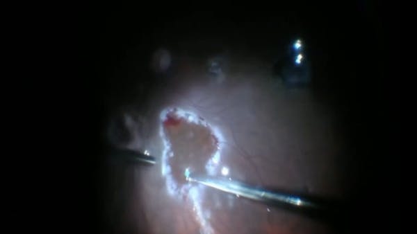 Autologous Retinal Transplant for Macular Hole Retinal Detachment thumbnail