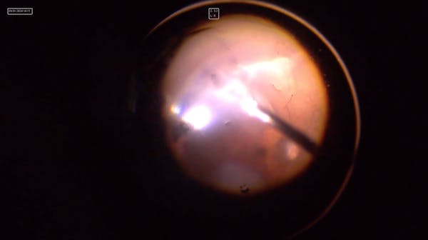 Relative Anterior Microphthalmos thumbnail