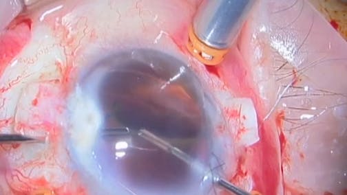 Ophthalmic Surgery, a School of Resilience