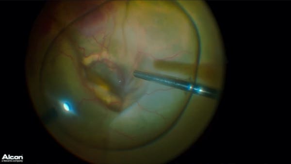 Coats Disease thumbnail