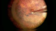 Myopic Macular Hole