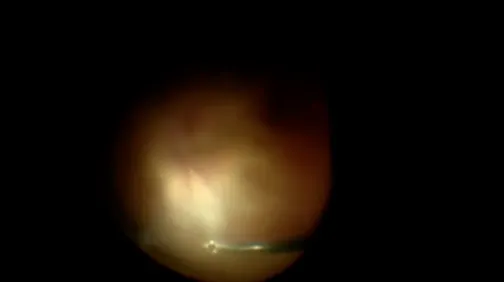 Lens-Sparing 25G-Short Pediatric Vitrectomy for Stage 5 ROP