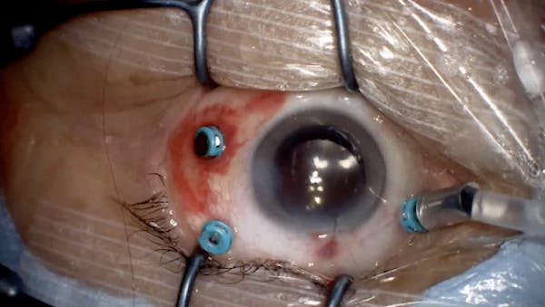 Suprachoroidal Infusion & Hemorrhage thumbnail