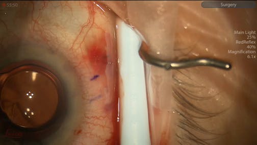 Combined Cataract Surgery and Xen Implantation