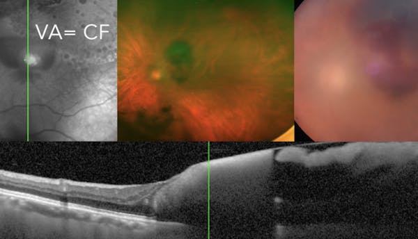 Subretinal Hemorrhage thumbnail