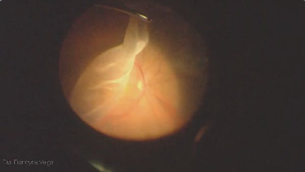 Giant Retinal Tear & Perfluoron thumbnail