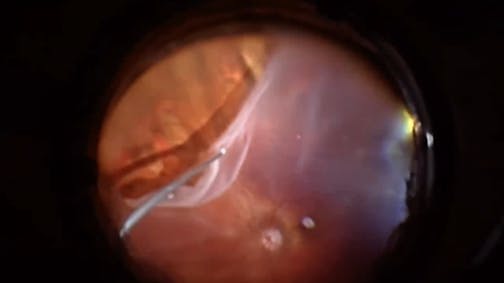 Vitrectomy for Giant Retinal Tear