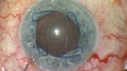 New Technique of Phaco Surgery in the Small Pupil
