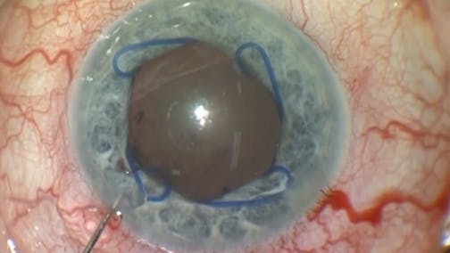 New Technique of Phaco Surgery in the Small Pupil