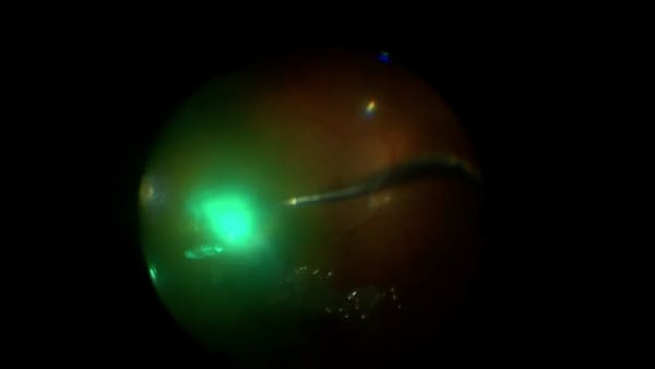 Acute Retinal Necrosis thumbnail