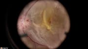 Diabetic Vitrectomy