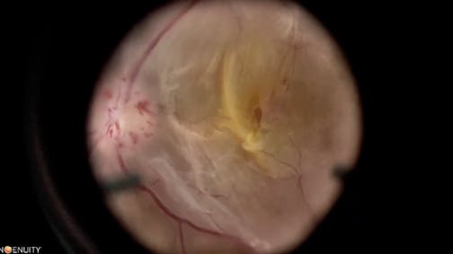 Diabetic Vitrectomy