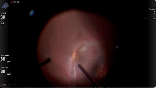 Traumatic Macular Tear