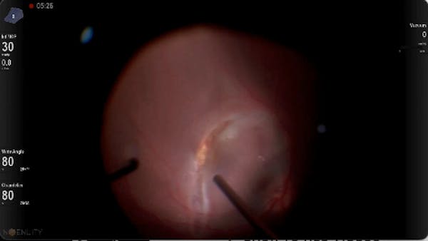 Trumatic Macular Tear thumbnail