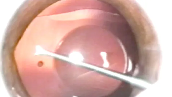 The Importance of Proper ICL Vaulting thumbnail