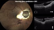 Morning Glory Syndrome & Macular Hole