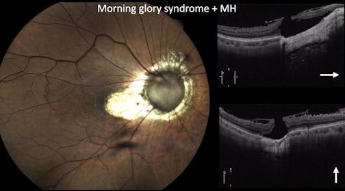 Morning Glory Syndrome & Macular Hole