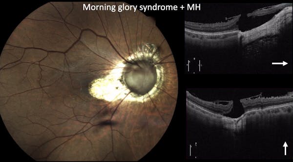 Morning Glory Syndrome & Macular Hole thumbnail