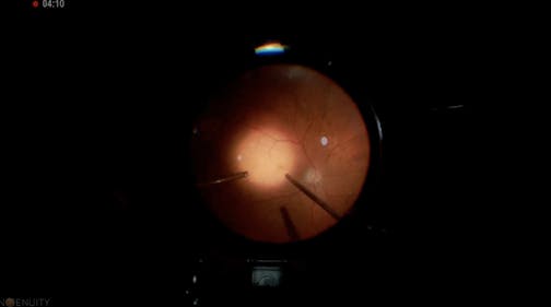 Macular Fold
